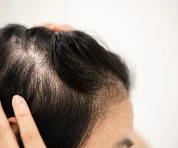 Regenerative Cell Therapy for Androgenetic Alopecia