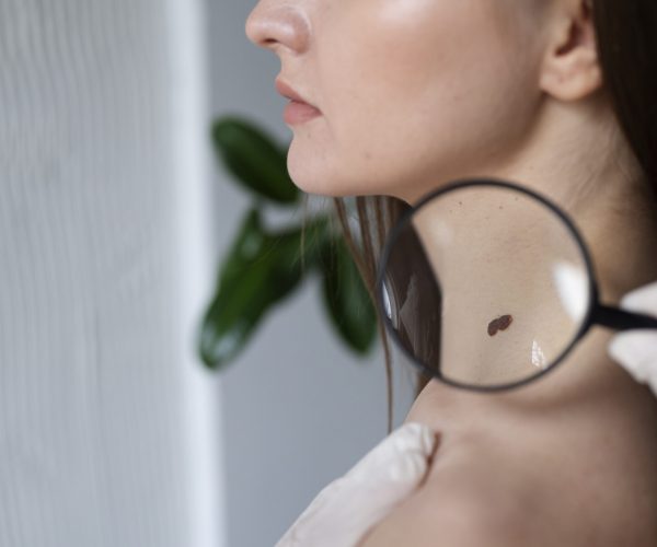 female-doctor-diagnosing-melanoma-body-female-patient