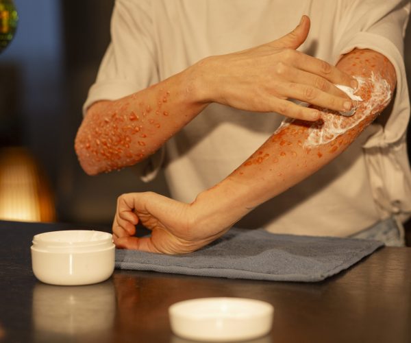 front-view-woman-experiencing-skin-disease