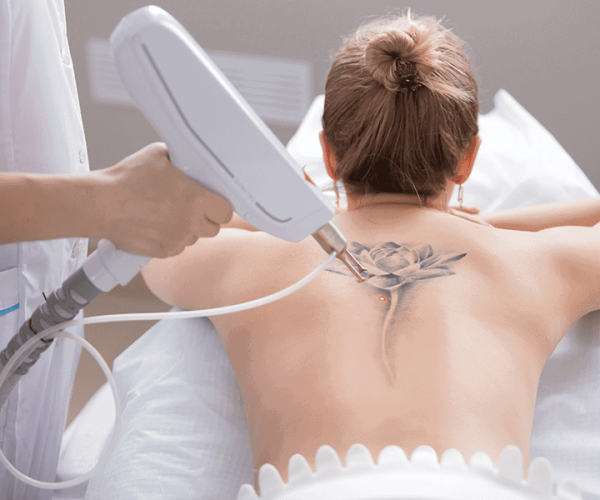laser-tattoo-removal