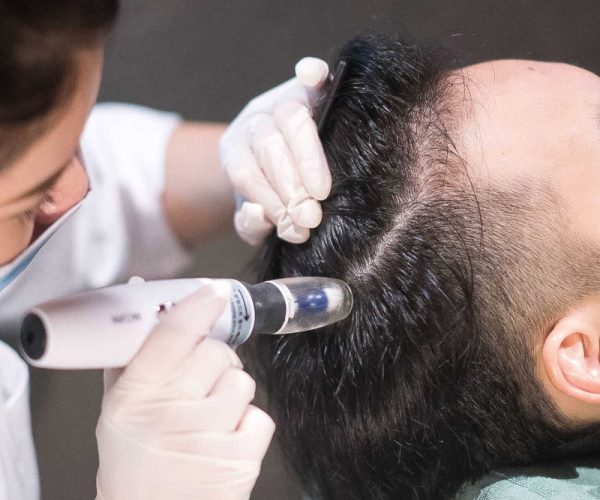 mesotherapy-for-hair-in-Pune