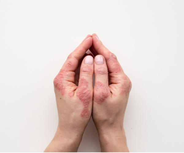 psoriasis