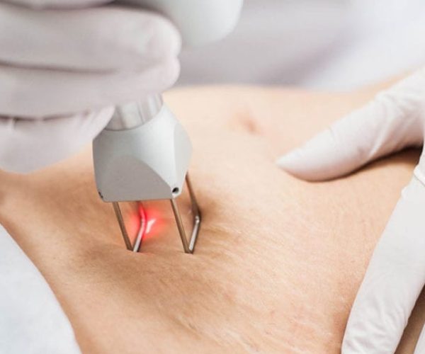 streach-mark-treatment-1