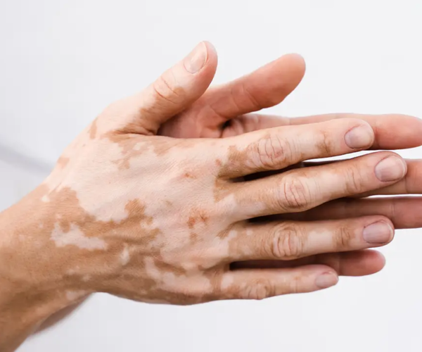 vitiligo