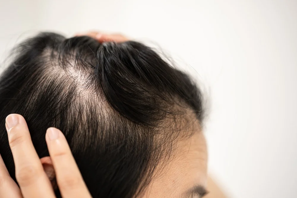 Regenerative Cell Therapy for Androgenetic Alopecia