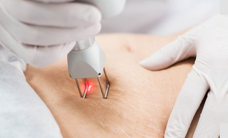 streach-mark-treatment-1